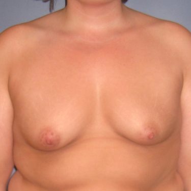 Subglandular Before Patient 3