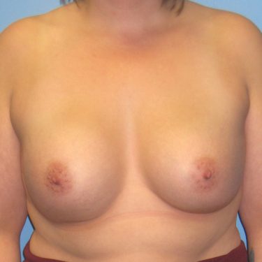 Subglandular After Patient 3