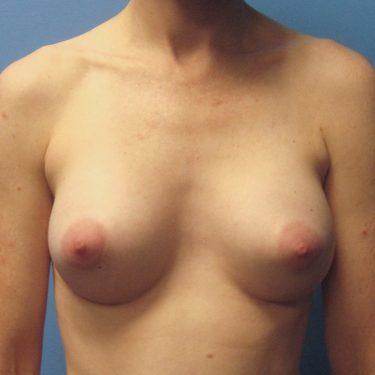 Breast Augmentation After Patient 3