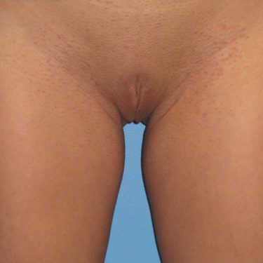 Labiaplasty After Patient 3