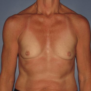 Breast Augmentation Before Patient 26