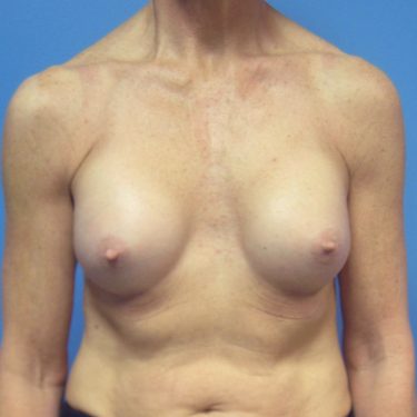 Breast Augmentation After Patient 26