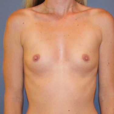 Breast Augmentation Before Patient 1