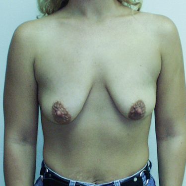 Breast Lift Before Patient 17