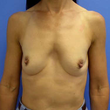 Breast Augmentation Before Patient 29