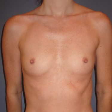 Breast Augmentation Before Patient 27