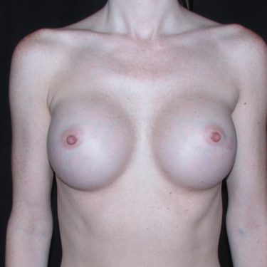 Breast Augmentation After Patient 27