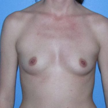 Breast Augmentation Before Patient 26