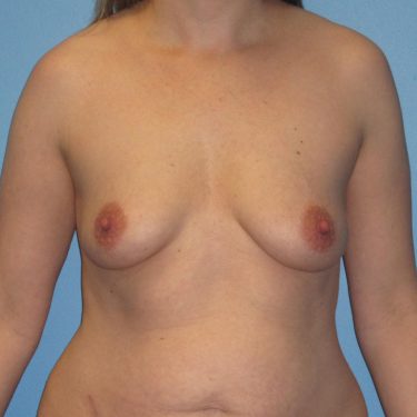 Subglandular Before Patient 27