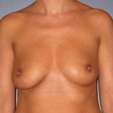 Breast Augmentation Before Patient 25