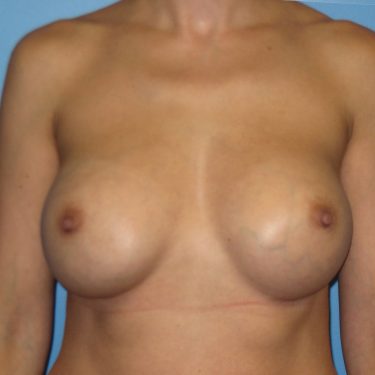 Breast Augmentation After Patient 25