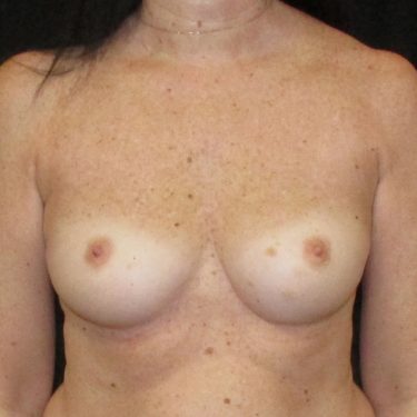 Breast Augmentation Before Patient 24