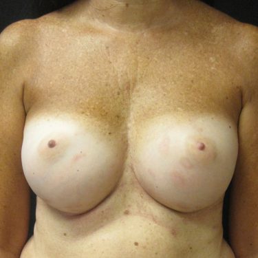 Breast Augmentation After Patient 24