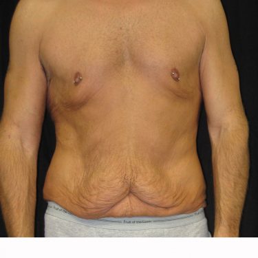 Tummy Tuck Before Patient 16