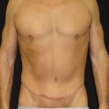 Tummy Tuck After Patient 16