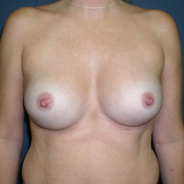 Breast Augmentation After Patient 21