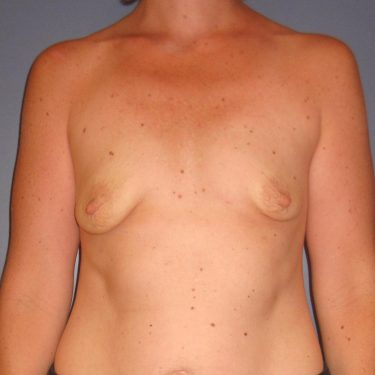 Dual-plane technique Before Patient 10