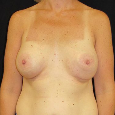 Dual-plane technique After Patient 10