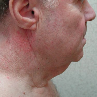 Neck Lift for Men Before Patient 2