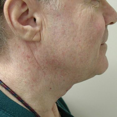Neck Lift for Men After Patient 2