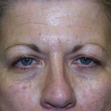 Eyes & Brow Before Patient 3