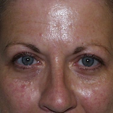 Eyes & Brow After Patient 3