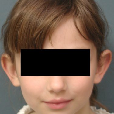 Ear Surgery Before Patient 3