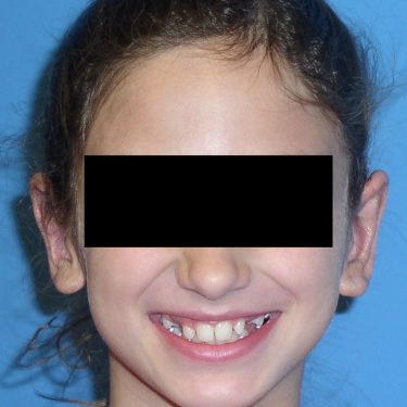 Ear Surgery After Patient 3