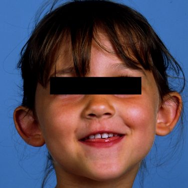 Ear Surgery Before Patient 1