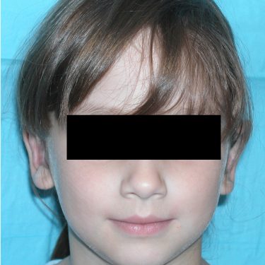 Ear Surgery After Patient 1