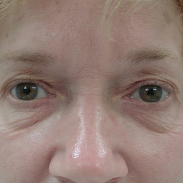 Eyes & Brow Before Patient 2