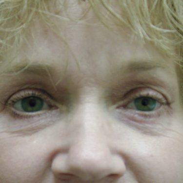 Eyes & Brow After Patient 2