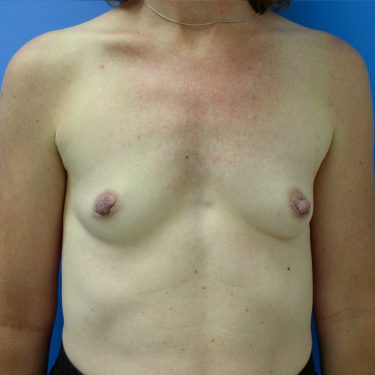 Breast Augmentation Before Patient 17