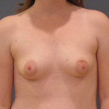 Breast Augmentation Before Patient 16