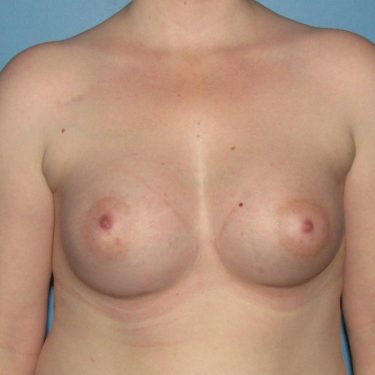 Breast Augmentation After Patient 16