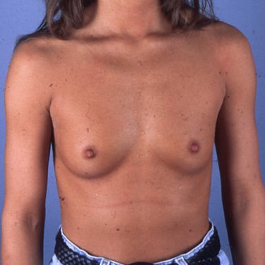 Breast Augmentation Before Patient 12