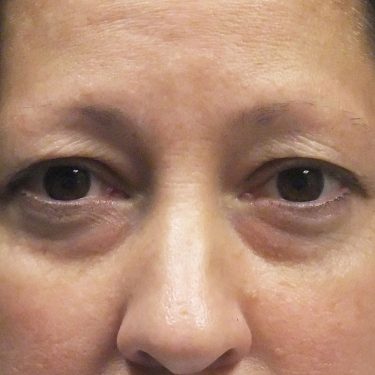 Eyes & Brow Before Patient 1