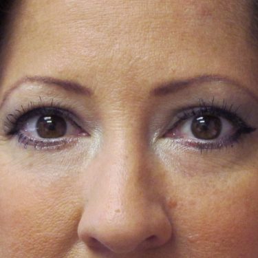 Eyes & Brow After Patient 1