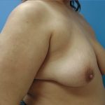 Breast Lift Before Patient Thumbnail 2
