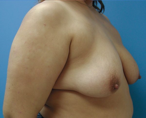 Breast Lift Before Patient 2