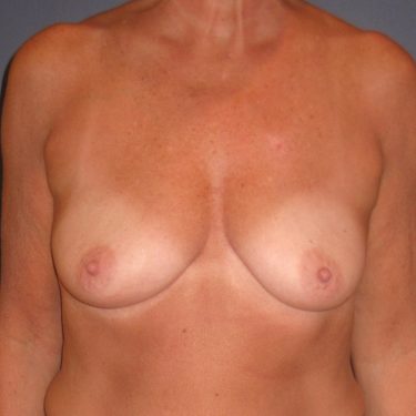 Subglandular Before Patient 26