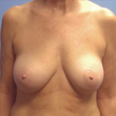 Subglandular After Patient 26