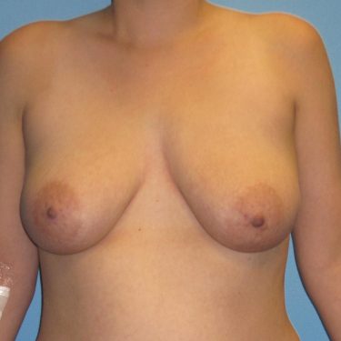 Breast Lift Before Patient 11