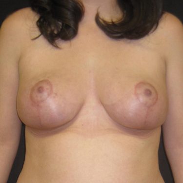 Breast Lift After Patient 11