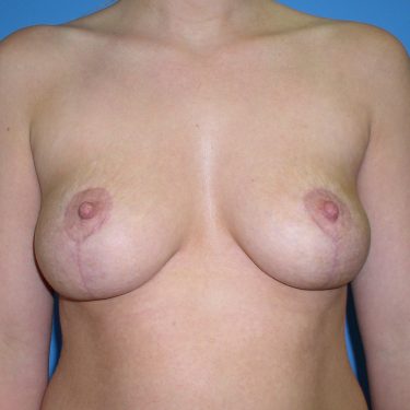 Breast Lift After Patient 13