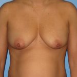 Breast Lift Before Patient Thumbnail 1