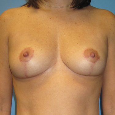 Breast Lift After Patient 12
