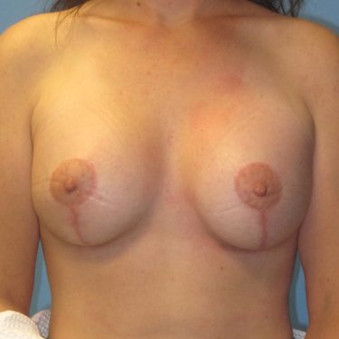 Breast Augmentation & Lift Before Patient 1
