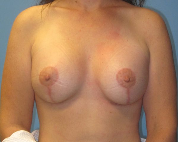 Breast Augmentation Before Patient 1