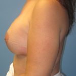 Breast Augmentation Before Patient Thumbnail 3
